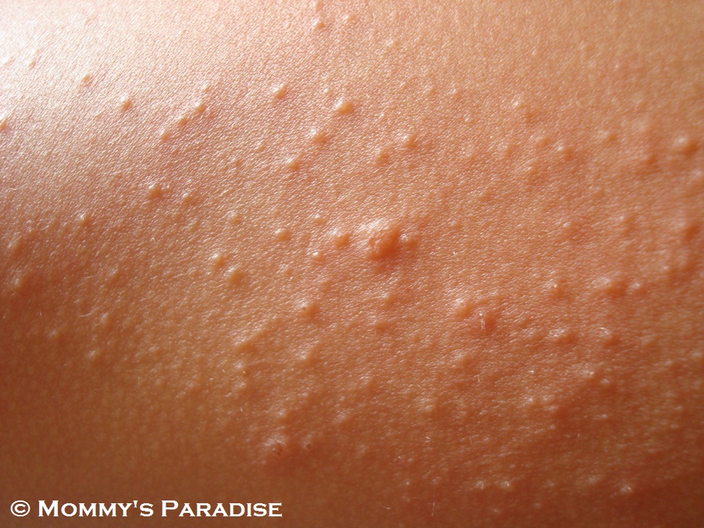 pimple like rash on legs #11