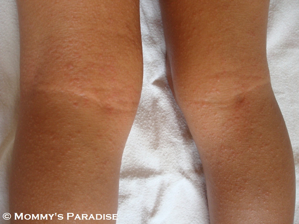 What causes a rash behind the knees?